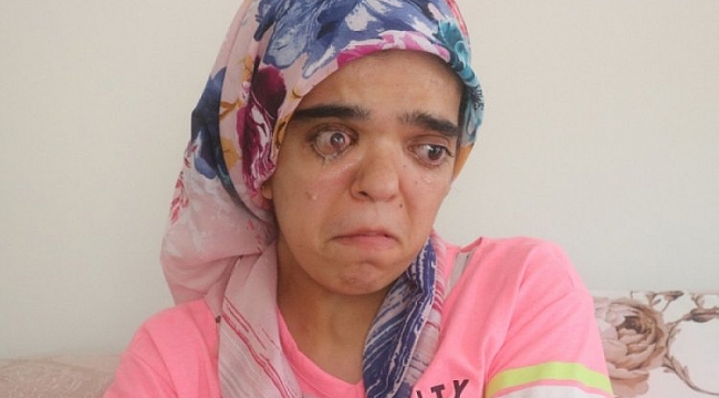 Güzelliğine kavuşmak için yardım bekliyor