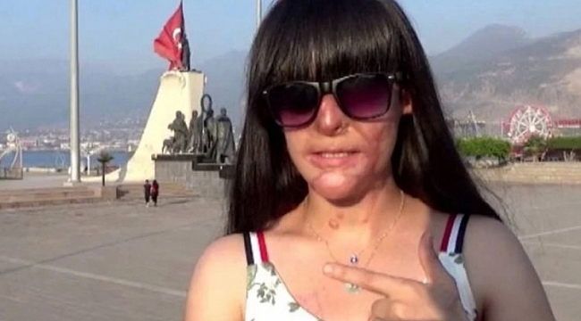 Yüzüne asit atan saldırganı affeden Berfin konuştu