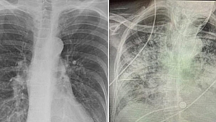 Koronavirüsün korkunç etkisi ortaya çıktı