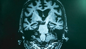 Basit bir kan testiyle Alzheimer teşhisi yapılabilecek 