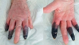 Koronavirüs hastası kangren oldu 