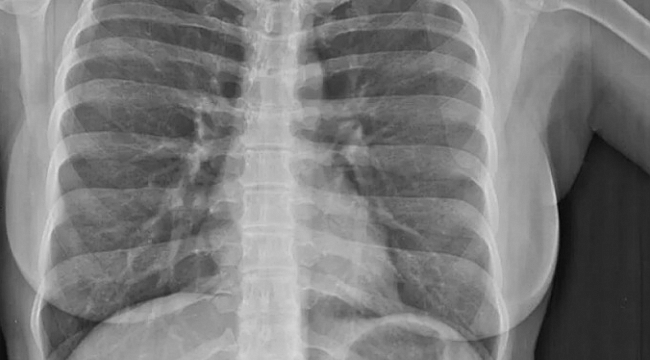Kovid korkusu tomografiyi 20 kat artırdı