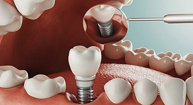 Diş tedavisinde implant zorlu bir süreç mi?