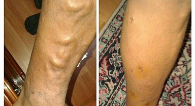 Sıcak havalarda varise dikkat!