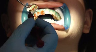 Diş beyazlatma yöntemleri neler? Beyazlatmak dişlere zarar verir mi?