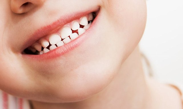 Çocuklarda diş çürüğü neden olur? Nelere dikkat edilmeli?