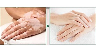 Dünyadaki birçok vitiligo hastası çareyi Bursa'da buluyor