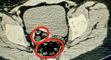 Kars'ta İranlı kadının makadından 94 parça uyuşturucu çıktı