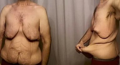 Obezite ameliyatlarından sonra oluşan deri sarkması tedavi edilebilir mi?