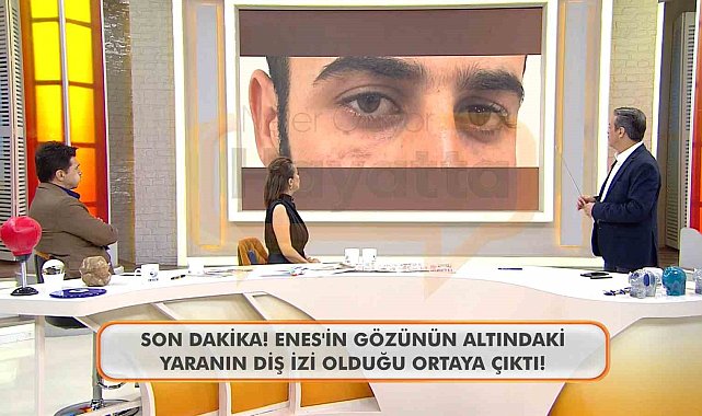 Canlı yayında Enes Güran'ın gözünün altındaki diş izine dikkat çekildi