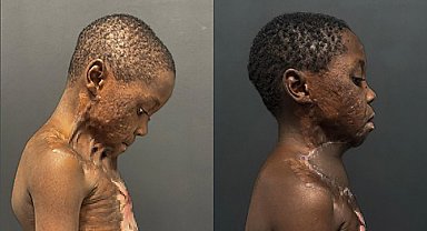 7 yaşındaki çocuğun boynu yandı, çenesi gövdesine yapıştı