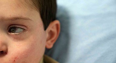 Yüzünün sol tarafı felç olan 4 yaşındaki Burak'a 'akupunktur' tedavisi umut oldu