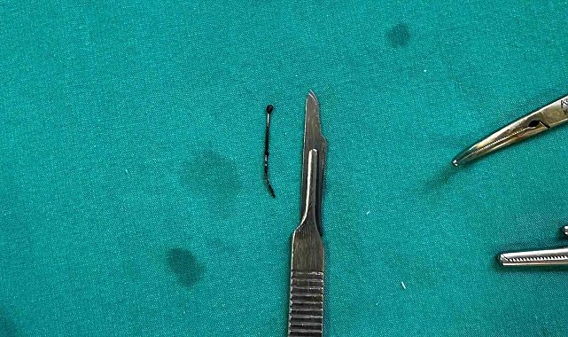 5 yaşındaki çocuğun yuttuğu toplu iğne ameliyatla çıkarıldı