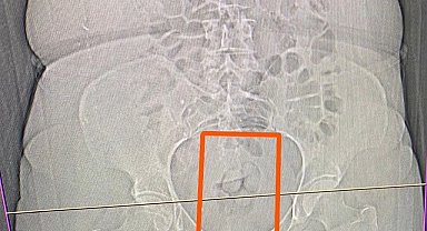 Midesinden 21,39 gram uyuşturucu çıktı