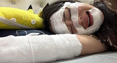 Vietnam'da doğum gününde elinde patlayan balon kadının yüzünü yaktı
