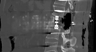 Bayburt'ta omur gövdesi çıkarılarak yapılan ameliyat başarıyla gerçekleşti