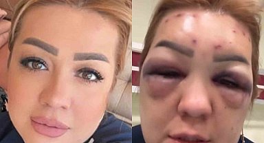 Botoks bu hale getirdi: Yüzü şişti tanınmayacak hale geldi