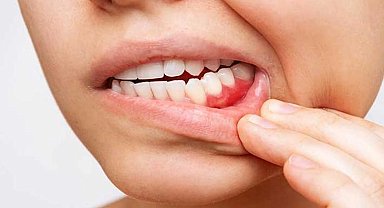 Diş eti çekilmesi diş kaybı ile sonuçlanabilir!