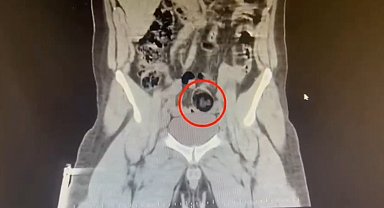 Kars'ta İranlı kuryenin makatından uyuşturucu çıktı