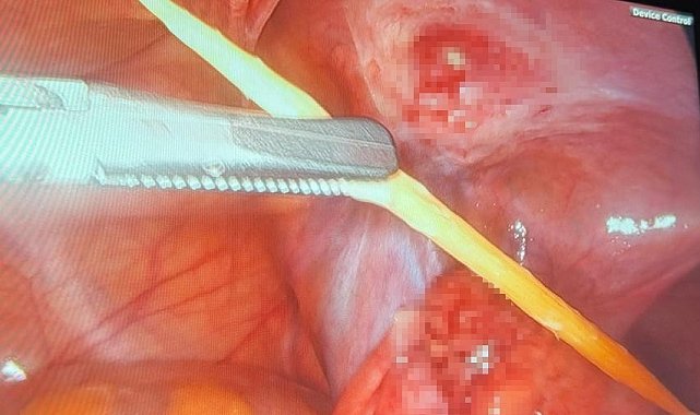 Sinop'ta 17 yaşındaki bir hastanın kalın bağırsağını delen kürdan kapalı yöntemle çıkarıldı