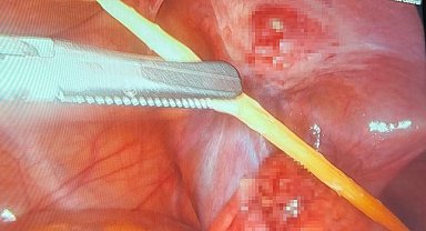 Sinop'ta 17 yaşındaki bir hastanın kalın bağırsağını delen kürdan kapalı yöntemle çıkarıldı