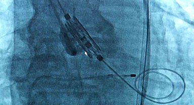 Uzmanlar uyarıyor: "Nefes darlığı, yorulmayı yaşlılığa bağlamayın, kalp hastalığının habercisi olabilir"