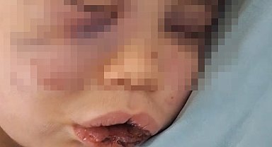 Vahşeti yaşayan 2 yaşındaki bebek hastanelik oldu