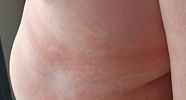 Çocuklarda besin alerjilerine dikkat: "Yiyeceklerin içeriği sorgulanmalı, anafilaksi hayatı tehdit edebilir"