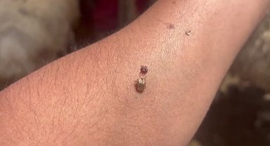 Artan kene vakaları alarm veriyor: Yaşlılar ve çocuklar tehlikede