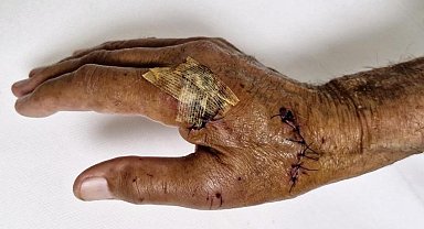 Duşakabin patladı, eline 20'ye yakın dikiş atıldı