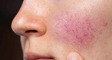 Gül hastalığı ihmal edilmemeli