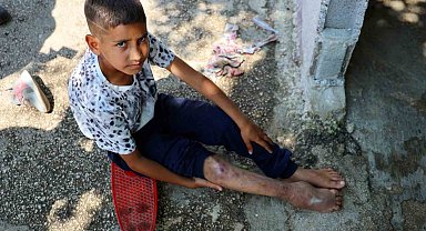 Kaza sonrası ayağı yanlış kaynadı, hayatı kaykay üzerinde geçiyor