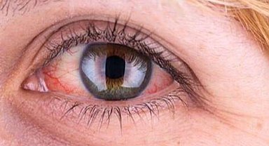 Yaz serinliği göz sağlığınızı tehdit etmesin: 6 koruyucu öneri