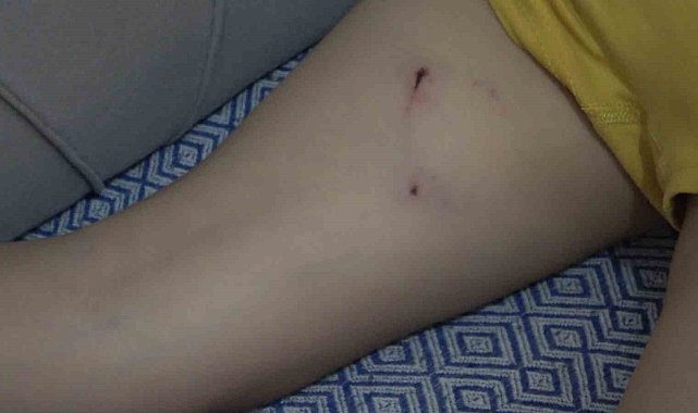 Rize'de 5 yaşındaki çocuk, sokak köpeğinin saldırısına uğradı