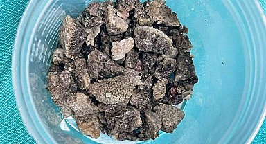 8 santimetrelik 'geyik boynuzu' böbrek taşı kapalı yöntemle çıkarıldı