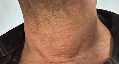 Kütahya'da dev guatr ameliyatsız tedavi edildi: Yüzde 90'dan fazla küçülme oldu