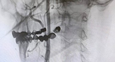Manisa Şehir Hastanesi'nde felç riskine karşı ameliyatsız çözüm