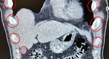 Midelerinden 136 kapsül uyuşturucu çıktı