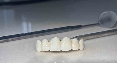 Özelde 8 bin TL olan kaplama, devlet hastanesinde 188 TL'ye yapılmaya başladı