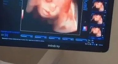 Sinop Atatürk Devlet Hastanesi'ne 4 boyutlu ultrason cihazı