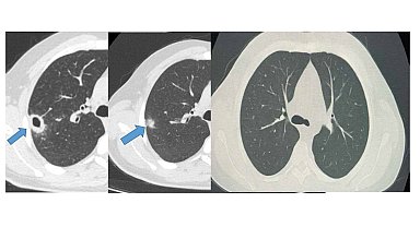 Bayburt'ta 50 yaşındaki hasta erken tanıyla sağlığına kavuştu