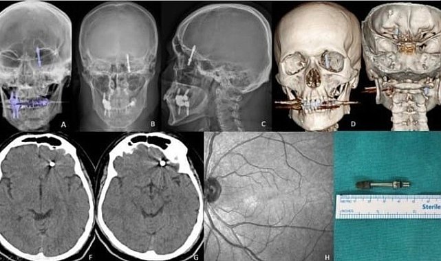 Beynine saplanan implant hayatını kararttı: 2 yıldır adalet bekliyor