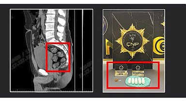 Tomografide şok eden görüntü...Uyuşturucu midesinden çıkarıldı