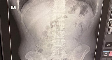 Uşak'ta midelerinden uyuşturucu çıktı: İranlı 3 kişi tutuklandı