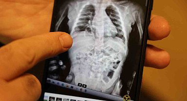 Doğuştan 200 binde bir görülen hastalıkla 2 yıl boyunca yaşayan çocuk sağlığına kavuştu