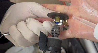 Batman'da parmağa sıkışan iki yüzük 'spiral makine' ile çıkarıldı