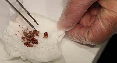 Elazığ'da estetik ameliyatta şaşırtan olay, burundan taş çıktı