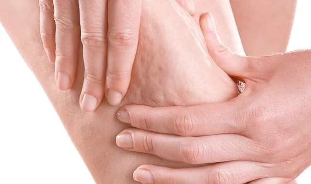 Prof. Dr. Karacalar'dan selülit uyarısı: Portakal kabuğu görüntüsü basit sorun değil!