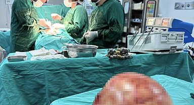 Van'da bir kadının karnından 35 santimetrelik dev kitle çıkarıldı