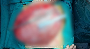 Kilo vermek için hastaneye giden çocuğun karnından 3,5 kiloluk kist çıktı